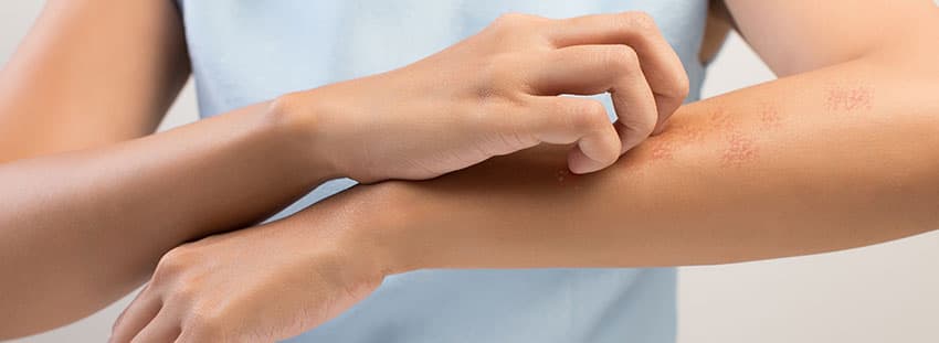 Eczema & Skin Allergies hero image