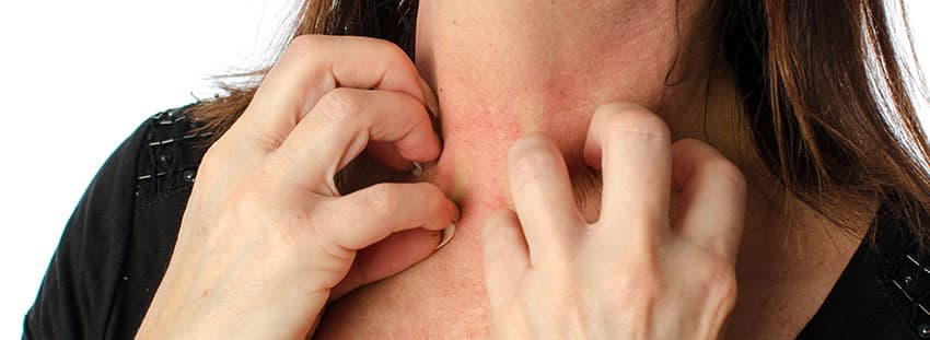 Eczema & Skin Allergies information